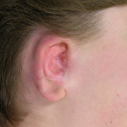 after ear reconstruction